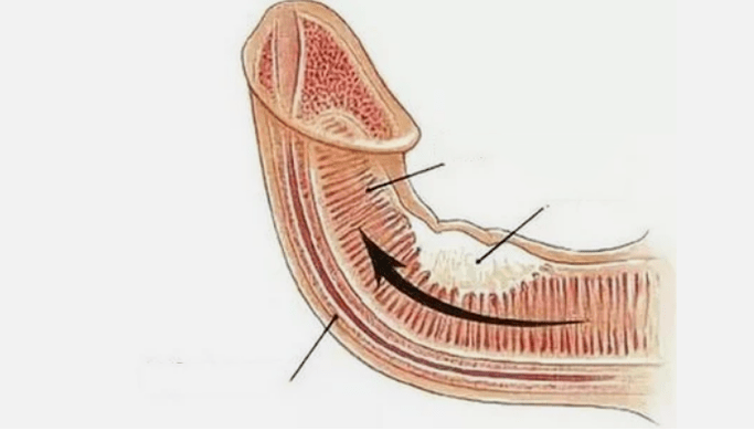 Eliminate venous flow